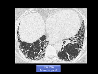 NIU (FPI)
Patrón en panal
 