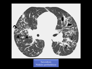 Sarcoidosis
Nódulos perilinfáticos
 