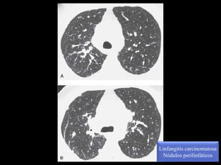 Linfangitis carcinomatosa
Nódulos perilinfáticos
 