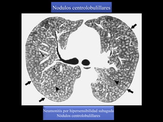 Neumonitis por hipersensibilidad subaguda
Nódulos centrolobulillares
Nodulos centrolobulillares
 