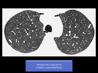 Bronquiolitis respiratoria
Nódulos centrolobulillares
 