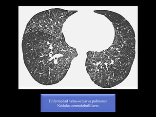 Enfermedad veno-oclusiva pulmonar
Nódulos centrolobulillares
 