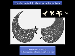 Nodulos centrolobulillares con árbol en brote
Bronquiolitis infecciosa
Nódulos centrolobulillares con árbol en brote
 