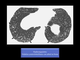 Panbronquiolitis
Nódulos centrolobulillares con árbol en brote
 