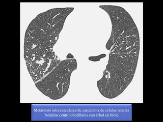 Metástasis intravasculares de carcinoma de células renales
Nódulos centrolobulillares con árbol en brote
 