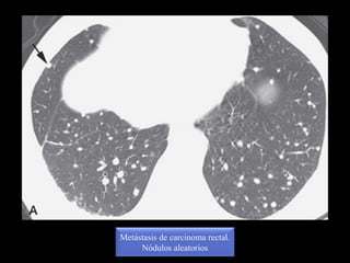 Metástasis de carcinoma rectal.
Nódulos aleatorios
 