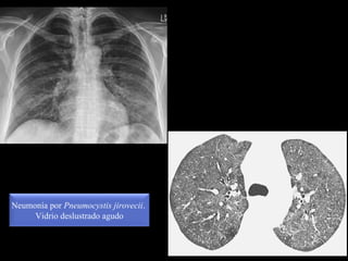 Neumonía por Pneumocystis jirovecii.
Vidrio deslustrado agudo
 