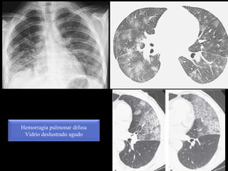 Hemorragia pulmonar difusa
Vidrio deslustrado agudo
 