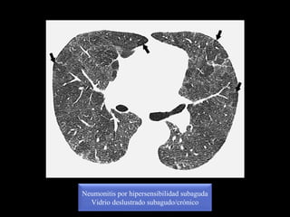 Neumonitis por hipersensibilidad subaguda
Vidrio deslustrado subagudo/crónico
 