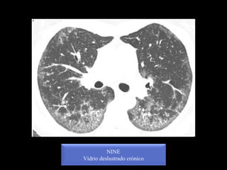NINE
Vidrio deslustrado crónico
 