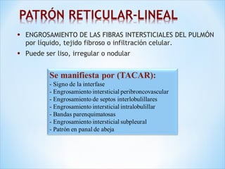 • ENGROSAMIENTO DE LAS FIBRAS INTERSTICIALES DEL PULMÓN
por líquido, tejido fibroso o infiltración celular.
• Puede ser liso, irregular o nodular
 