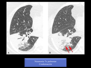 Neumonía Tx pulmonar
Condensación
 