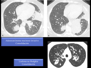Adenocarcinoma mucinoso invasivo
Consolidación
Linfoma no Hodgkin
Consolidación
 