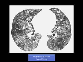 Proteinosis alveolar
Crazy Paving
 