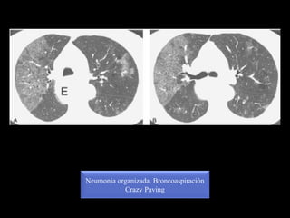 Neumonía organizada. Broncoaspiración
Crazy Paving
 
