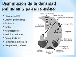  Panal de abeja
 Quistes pulmonares
 Enfisema
 Bullas
 Neumatoceles
 Nódulos cavitados
 Bronquiectasias
 Perfusión en mosaico
 Atrapamiento aéreo
 