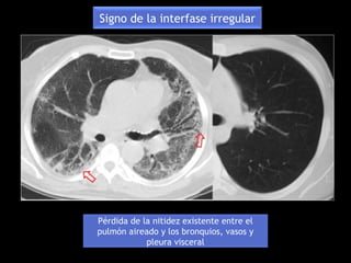 Pérdida de la nitidez existente entre el
pulmón aireado y los bronquios, vasos y
pleura visceral
Signo de la interfase irregular
 