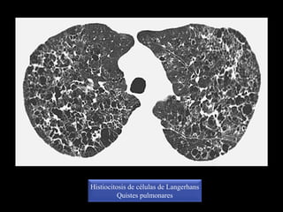 Histiocitosis de células de Langerhans
Quistes pulmonares
 