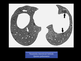 Neumonía intersticial linfoide
Quistes pulmonares
 