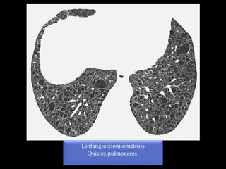 Linfangioleiomiomatosis
Quistes pulmonares
 