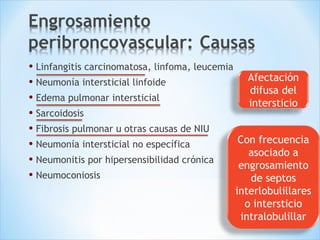 • Linfangitis carcinomatosa, linfoma, leucemia
• Neumonía intersticial linfoide
• Edema pulmonar intersticial
• Sarcoidosis
• Fibrosis pulmonar u otras causas de NIU
• Neumonía intersticial no específica
• Neumonitis por hipersensibilidad crónica
• Neumoconiosis
Afectación
difusa del
intersticio
Con frecuencia
asociado a
engrosamiento
de septos
interlobulillares
o intersticio
intralobulillar
 
