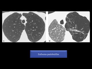 Enfisema panlobulillar
 