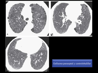 Enfisema paraseptal y centrolobulillar
 