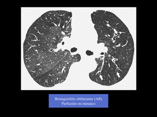 Bronquiolitis obliterante (AR)
Perfusión en mosaico
 
