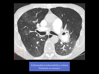 Enfermedad tromboembólica crónica
Perfusión en mosaico
 