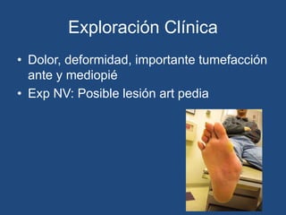 Exploración Clínica
• Dolor, deformidad, importante tumefacción
ante y mediopié
• Exp NV: Posible lesión art pedia
 