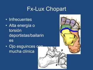 Fx-Lux Chopart
• Infrecuentes
• Alta energía o
torsión
deportistas/bailarin
es
• Ojo esguinces con
mucha clínica
 