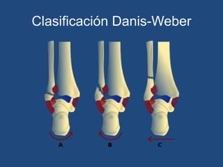 Clasificación Danis-Weber
 