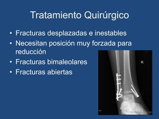 Tratamiento Quirúrgico
• Fracturas desplazadas e inestables
• Necesitan posición muy forzada para
reducción
• Fracturas bimaleolares
• Fracturas abiertas
 