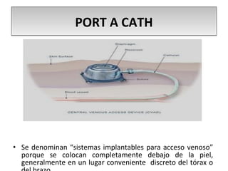 PORT A CATHPORT A CATH
• Se denominan “sistemas implantables para acceso venoso”
porque se colocan completamente debajo de la piel,
generalmente en un lugar conveniente discreto del tórax o
 
