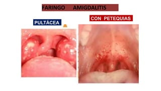 FARINGO AMIGDALITIS
PULTÁCEA
CON PETEQUIAS
 