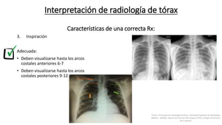 3. Inspiración
Adecuada:
• Deben visualizarse hasta los arcos
costales anteriores 6-7
• Deben visualizarse hasta los arcos
costales posteriores 9-12
Interpretación de radiología de tórax
Características de una correcta Rx:
Felson, Principios de radiología torácica. Sociedad Española de Radiología
Médica - SERAM. Advanced Trauma Life Support ATLS, Colegio Americano
de Cirujanos.
 