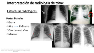 Partes blandas
Grasa
Aire Enfisema
Cuerpos extraños
Mamas
Interpretación de radiología de tórax
Estructuras radiológicas:
Felson, Principios de radiología torácica. Sociedad Española de Radiología
Médica - SERAM. Advanced Trauma Life Support ATLS, Colegio Americano
de Cirujanos.
 