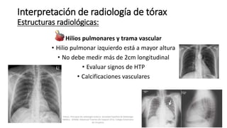 Hilios pulmonares y trama vascular
• Hilio pulmonar izquierdo está a mayor altura
• No debe medir más de 2cm longitudinal
• Evaluar signos de HTP
• Calcificaciones vasculares
Interpretación de radiología de tórax
Estructuras radiológicas:
Felson, Principios de radiología torácica. Sociedad Española de Radiología
Médica - SERAM. Advanced Trauma Life Support ATLS, Colegio Americano
de Cirujanos.
 