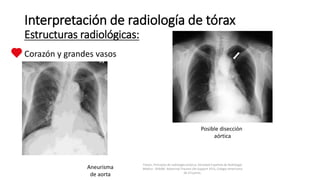 Corazón y grandes vasos
Interpretación de radiología de tórax
Estructuras radiológicas:
Felson, Principios de radiología torácica. Sociedad Española de Radiología
Médica - SERAM. Advanced Trauma Life Support ATLS, Colegio Americano
de Cirujanos.
Aneurisma
de aorta
Posible disección
aórtica
 