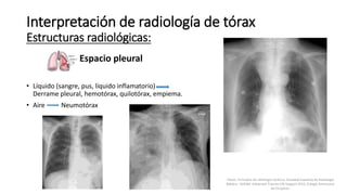 Espacio pleural
• Líquido (sangre, pus, líquido inflamatorio)
Derrame pleural, hemotórax, quilotórax, empiema.
• Aire Neumotórax
Interpretación de radiología de tórax
Estructuras radiológicas:
Felson, Principios de radiología torácica. Sociedad Española de Radiología
Médica - SERAM. Advanced Trauma Life Support ATLS, Colegio Americano
de Cirujanos.
 