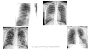 Felson, Principios de radiología torácica. Sociedad Española de Radiología
Médica - SERAM. Advanced Trauma Life Support ATLS, Colegio Americano
de Cirujanos.
 