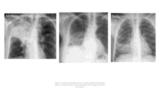 Felson, Principios de radiología torácica. Sociedad Española de Radiología
Médica - SERAM. Advanced Trauma Life Support ATLS, Colegio Americano
de Cirujanos.
 