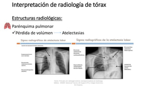 Parénquima pulmonar
Pérdida de volúmen Atelectasias
Interpretación de radiología de tórax
Estructuras radiológicas:
Felson, Principios de radiología torácica. Sociedad Española de Radiología
Médica - SERAM. Advanced Trauma Life Support ATLS, Colegio Americano
de Cirujanos.
 