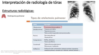 Parénquima pulmonar
Interpretación de radiología de tórax
Estructuras radiológicas:
Felson, Principios de radiología torácica. Sociedad Española de Radiología
Médica - SERAM. Advanced Trauma Life Support ATLS, Colegio Americano
de Cirujanos.
 