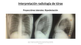 Interpretación radiología de tórax
Proyecciónes laterales: Bipedestación
Felson, Principios de radiología torácica. Sociedad Española de Radiología
Médica - SERAM. Advanced Trauma Life Support ATLS, Colegio Americano
de Cirujanos.
 