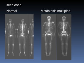 scan oseo Normal   Metástasis multiples 
