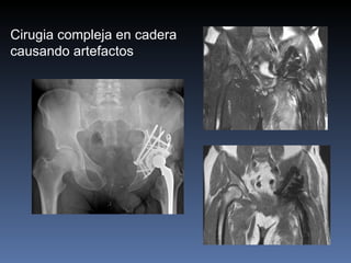 Cirugia compleja en cadera causando artefactos 