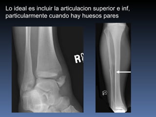 Lo ideal es incluir la articulacion superior e inf, particularmente cuando hay huesos pares  