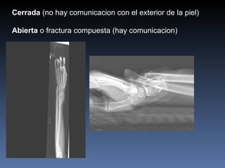 Cerrada  (no hay comunicacion con el exterior de la piel)  Abierta  o fractura compuesta (hay comunicacion) 