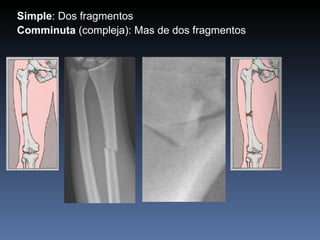 Simple : Dos fragmentos Comminuta  (compleja): Mas de dos fragmentos  